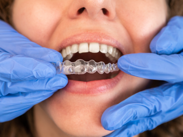 Totalcare Dental and Dermal Introduces Invisalign Orthodontic Care in Bondi Junction