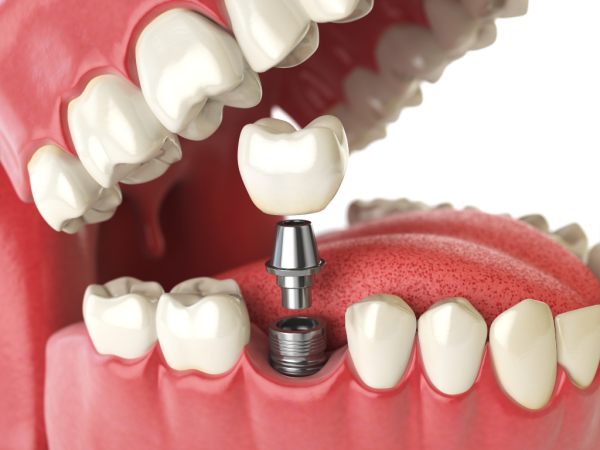 JC Dental Como Unveils Advanced Single Dental Implants in Perth