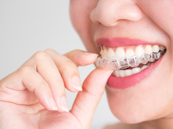 Totalcare Dental and Dermal Provides Advanced Invisalign Teeth Services in Bondi Junction