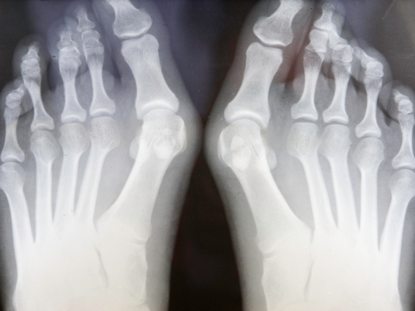 Align Health Collective Podiatrist Introduces Specialised Bunion Treatment for Effective Relief in Kew