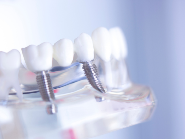 Totalcare Dental and Dermal Unveils Advanced All-On-4 Dental Implant Services in Sydney