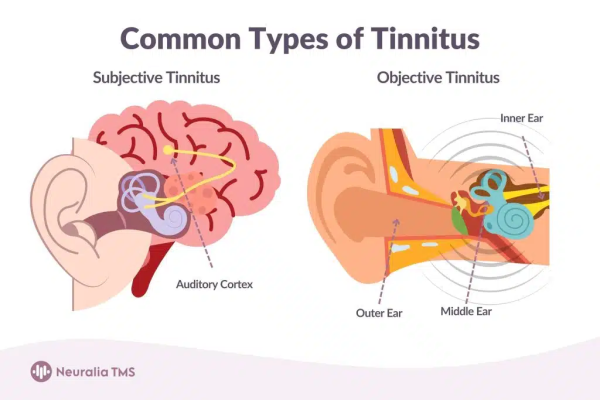 Neuralia TMS Offers Innovative Tinnitus Treatment in Perth, WA