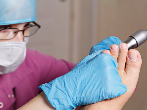 Align Health Collective Now Offers Corns and Callus Treatment in South Brisbane Podiatry Clinic