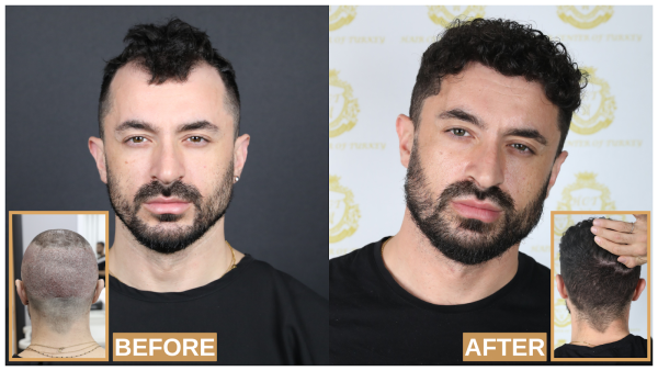 Hair Center of Turkey Revolutionizes Hair Restoration with Unmatched Expertise and Patient-Centric Care