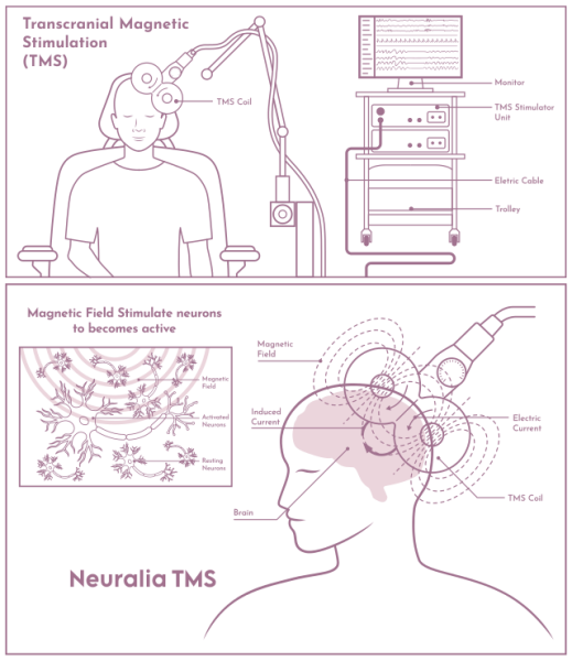 Neuralia TMS Introduces PTSD-Focused TMS Therapy in Perth