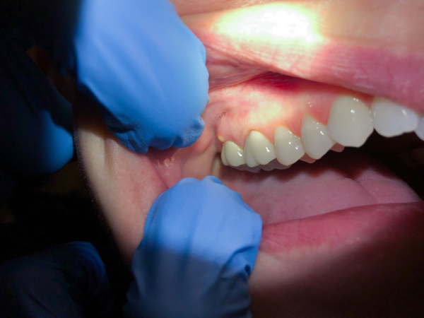 Emergency Dentist Perth Provides Fast and Reliable Care for Dental Emergencies